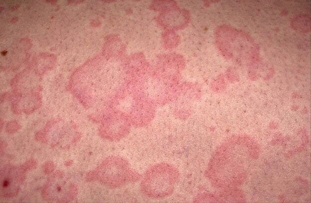 alergija na parazite